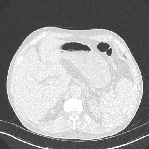 Caplan syndrome (Radiopaedia 56667-63530 Axial lung window 189).jpg
