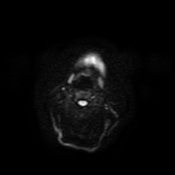 Carcinoma ex-pleomorphic adenoma of parotid (Radiopaedia 28383-28627 Ax DWI B-500 GE 43).jpg