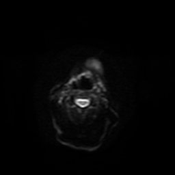 Carcinoma ex-pleomorphic adenoma of parotid (Radiopaedia 28383-28627 Ax DWI B-500 GE 5).jpg