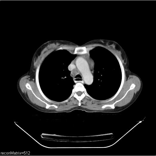 File:Carcinoma of esophagus (Radiopaedia 27356-27550 A 23).jpg