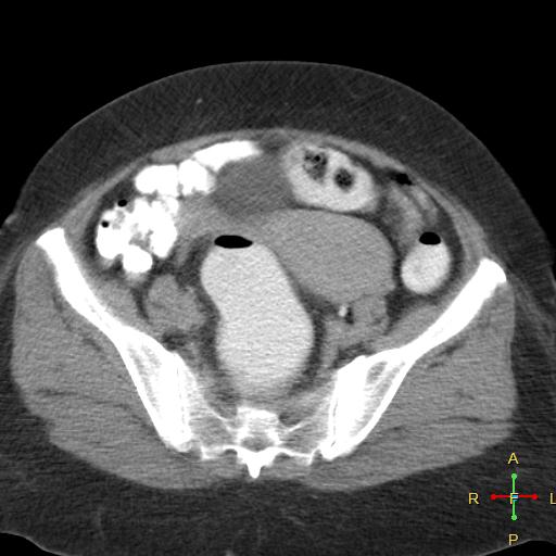 File:Carcinoma of sigmoid colon (Radiopaedia 23071-23100 C+ delayed 21).jpg