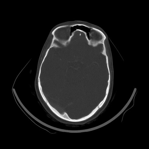 Carcinoma of the maxillary antrum (Radiopaedia 53805-59888 Axial bone window 5).jpg