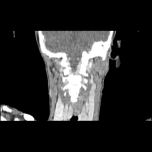 Carcinoma of the maxillary antrum (Radiopaedia 53805-59888 Coronal C+ delayed 112).jpg