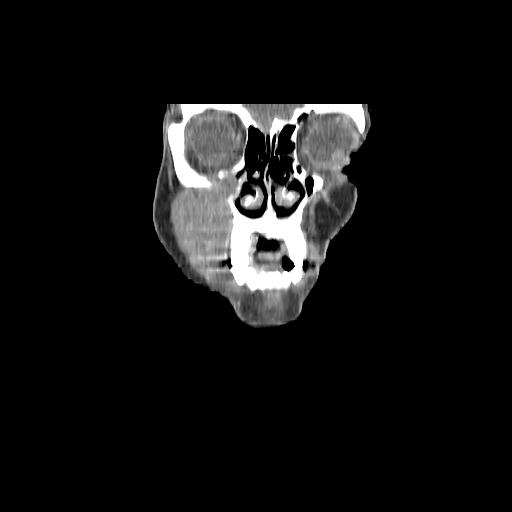 Carcinoma of the maxillary antrum (Radiopaedia 53805-59888 Coronal C+ delayed 21).jpg