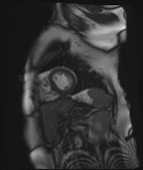 Cardiac amyloidosis (Radiopaedia 51404-57150 Sagittal CINE SSFP 101).jpg