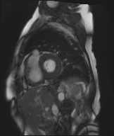 Cardiac amyloidosis (Radiopaedia 51404-57150 Sagittal CINE SSFP 213).jpg