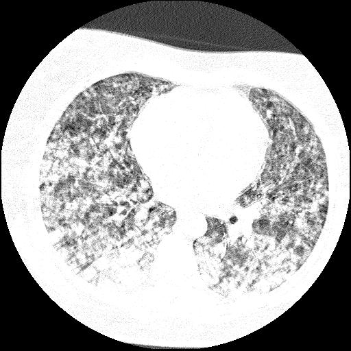Cardiac angiosarcoma (Radiopaedia 66010-75181 Axial lung window 43).jpg