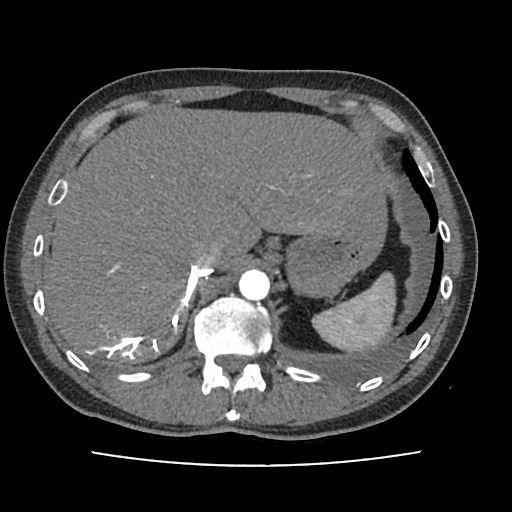 Cardiac tamponade (Radiopaedia 78607-91368 Axial C+ CTPA 91).jpg