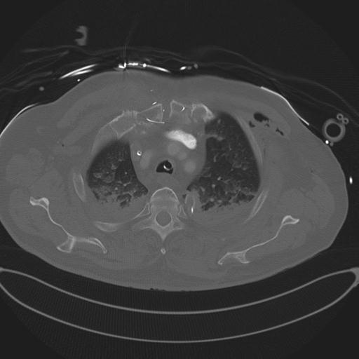 Cardiac trauma (Radiopaedia 32874-33858 Axial bone window 19).jpg