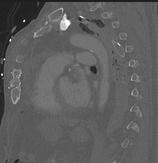 Cardiac trauma (Radiopaedia 32874-33858 Sagittal bone window 17).jpg