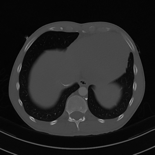 Cardiac tumor - undifferentiated pleomorphic sarcoma (Radiopaedia 45844-50134 Axial bone window 57).png