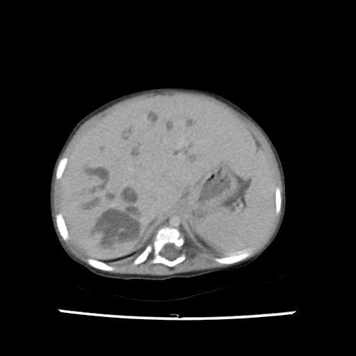 Caroli disease with autosomal recessive polycystic kidney disease (ARPKD) (Radiopaedia 89651-106703 B 43).jpg