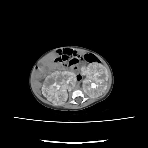 Caroli disease with autosomal recessive polycystic kidney disease (ARPKD) (Radiopaedia 89651-106703 E 133).jpg