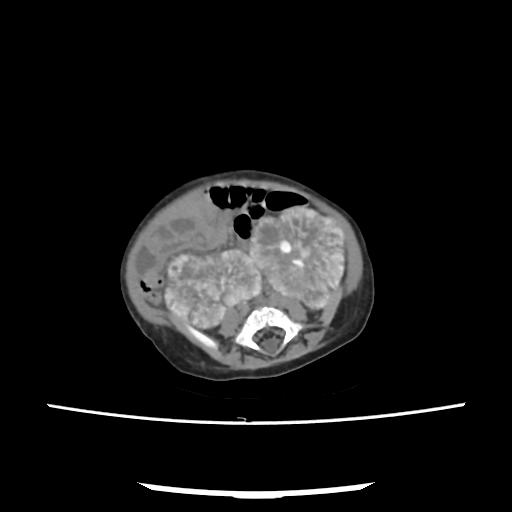 Caroli disease with autosomal recessive polycystic kidney disease (ARPKD) (Radiopaedia 89651-106703 E 165).jpg