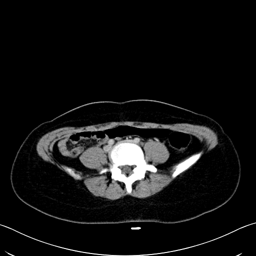 Caroli disease with medullary sponge kidney (Radiopaedia 82622-96804 C 49).jpg