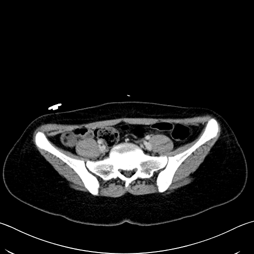 File:Caroli disease with medullary sponge kidney (Radiopaedia 82622-96804 C 55).jpg