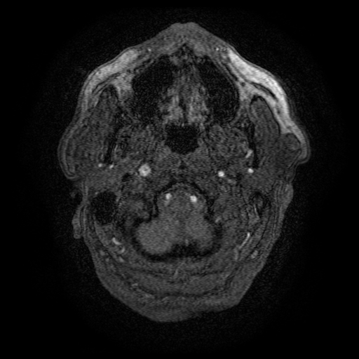 Carotid arterial dissection with acute cerebral infarction (Radiopaedia 26636-26784 MRA 169).jpg