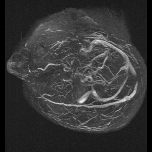 Carotid arterial dissection with acute cerebral infarction (Radiopaedia 26636-26784 MRV 14).jpg