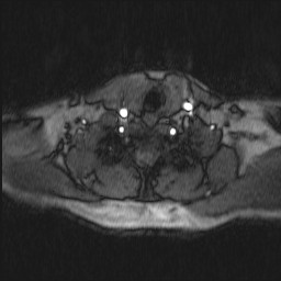 Carotid artery dissection (Radiopaedia 28441-28689 Axial MRA 17).jpg