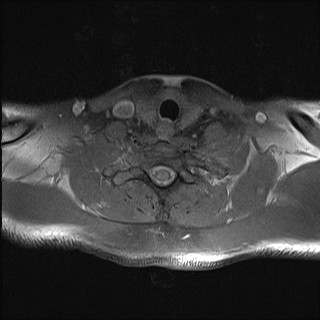 File:Carotid artery dissection (Radiopaedia 28441-28689 Axial T1 fat sat 9).jpg