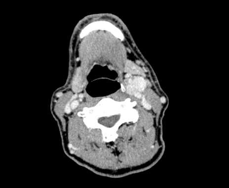 Carotid body tumor (Radiopaedia 61750-69757 Axial Post contrast 52).jpg