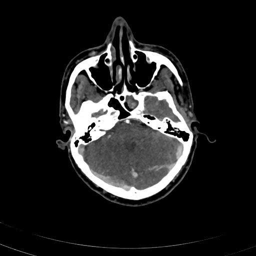 File:Carotid body tumor (Radiopaedia 83615-98727 A 15).jpg