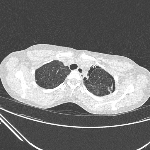 File:Catamenial pneumothorax (Radiopaedia 27946-28197 lung window 37).jpg