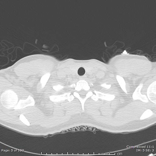 Catamenial pneumothorax (Radiopaedia 54382-60600 Axial non-contrast 5).jpg