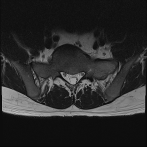 File:Cauda equina syndrome (Radiopaedia 53615-59672 Axial T2 5).png