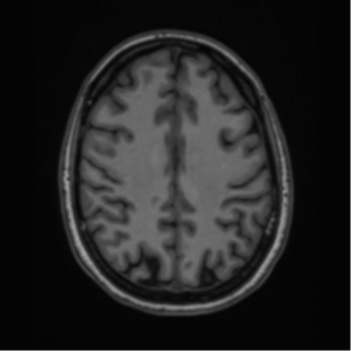 Cavernoma with bleed - midbrain (Radiopaedia 54546-60774 Axial T1 37).png