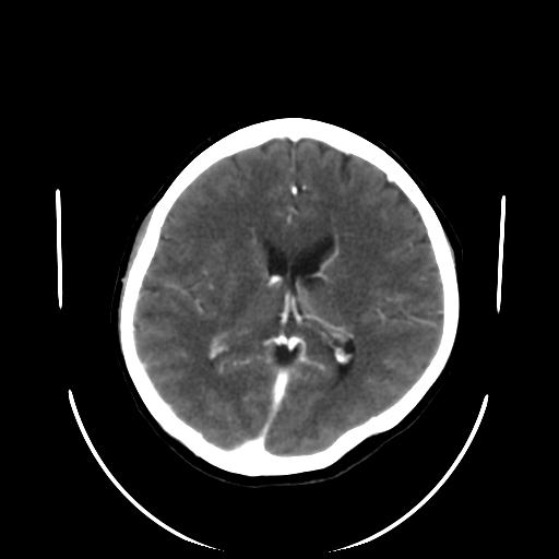 File:Cavernoma with developmental venous anomaly (Radiopaedia 22470-22506 C+ arterial phase 21).jpg