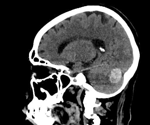 Cavernous hemangioma of the cerebellar falx (Radiopaedia 73025-83723 B 203).jpg