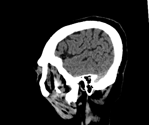 Cavernous hemangioma of the cerebellar falx (Radiopaedia 73025-83723 B 275).jpg