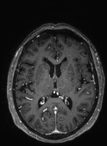 Cavernous hemangioma of the cerebellar falx (Radiopaedia 73025-83724 Axial T1 C+ 157).jpg