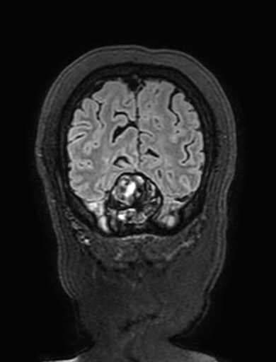 Cavernous hemangioma of the cerebellar falx (Radiopaedia 73025-83724 Coronal FLAIR 316).jpg