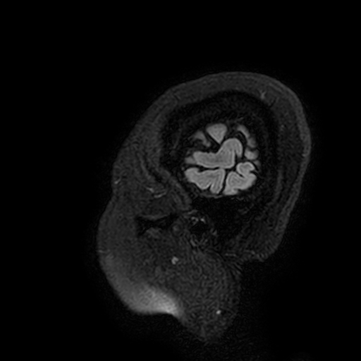 Cavernous hemangioma of the cerebellar falx (Radiopaedia 73025-83724 Sagittal FLAIR 212).jpg