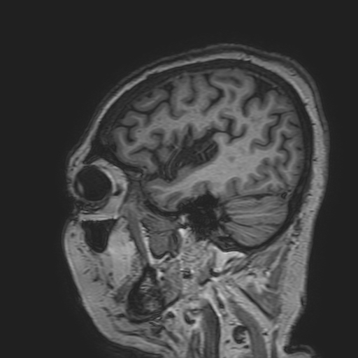 File:Cavernous hemangioma of the cerebellar falx (Radiopaedia 73025-83724 Sagittal T1 47).jpg