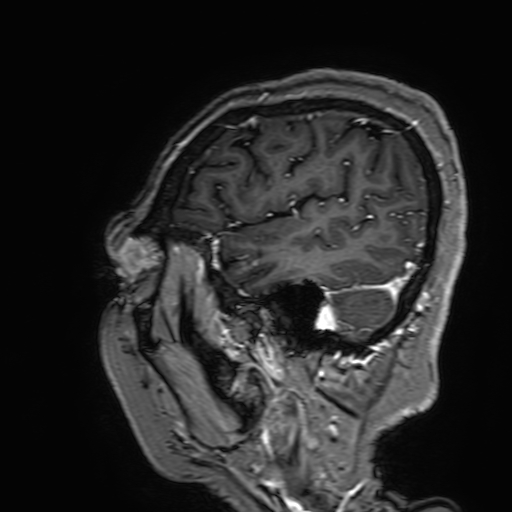File:Cavernous hemangioma of the cerebellar falx (Radiopaedia 73025-83724 Sagittal T1 C+ 175).jpg