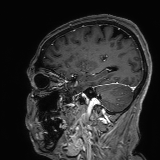 Cavernous hemangioma of the cerebellar falx (Radiopaedia 73025-83724 Sagittal T1 C+ 63).jpg