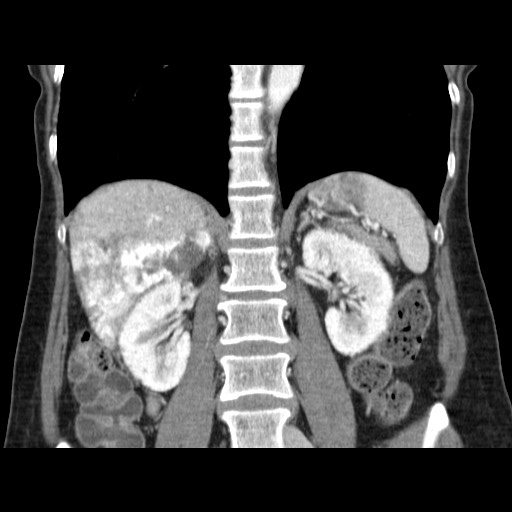 Cavernous hepatic hemangioma (Radiopaedia 75441-86667 C 91).jpg