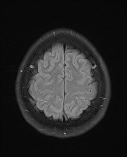 File:Cavernous sinus meningioma (Radiopaedia 63682-72367 Axial FLAIR 19).jpg
