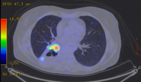 File:Cavitating lung mass - squamous cell carcinoma (Radiopaedia 48047-52853 A 53).png