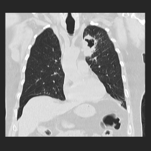 File:Cavitating pulmonary metastases (Radiopaedia 89545-106544 Coronal lung window 15).jpg