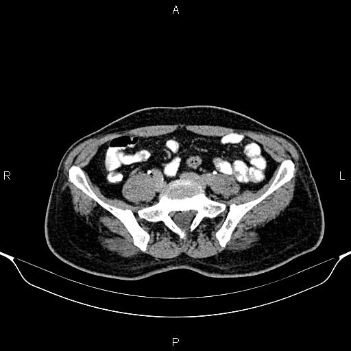 Cecal adenocarcinoma (Radiopaedia 85324-100916 Axial C+ delayed 69).jpg