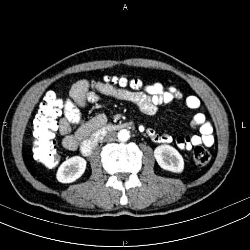 File:Cecal cancer with appendiceal mucocele (Radiopaedia 91080-108651 A 90).jpg