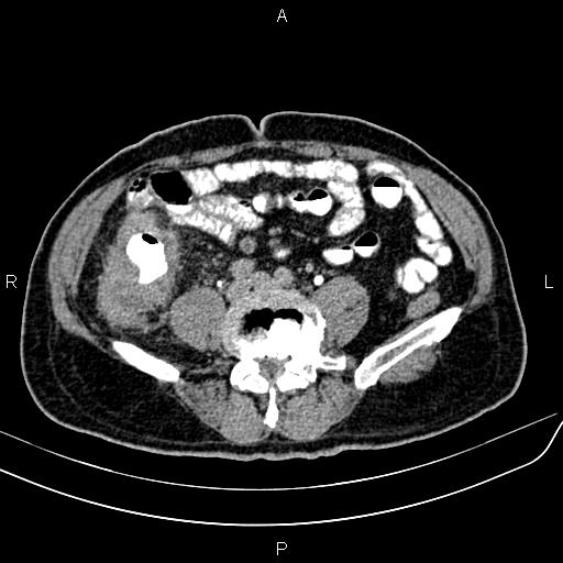 File:Cecal cancer with appendiceal mucocele (Radiopaedia 91080-108651 Axial C+ delayed 48).jpg