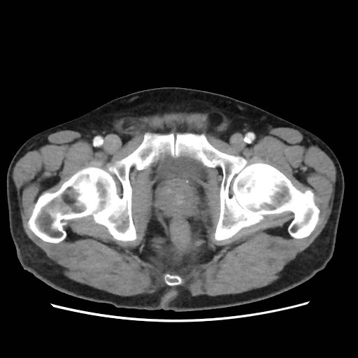 Cecal mass causing appendicitis (Radiopaedia 59207-66531 A 86).jpg