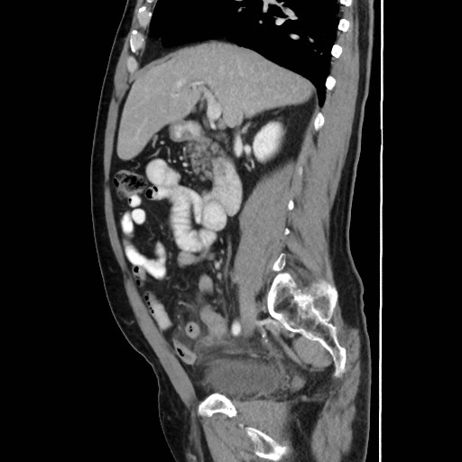 Cecal mass causing appendicitis (Radiopaedia 59207-66531 C 25).jpg