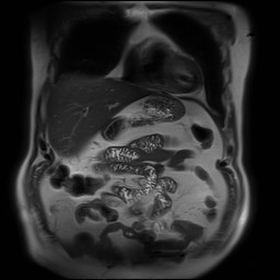 File:Cecal mass causing appendicitis (Radiopaedia 59207-66532 Coronal T2 10).jpg