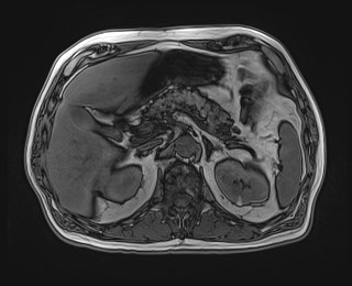 Cecal mass causing appendicitis (Radiopaedia 59207-66532 D 45).jpg